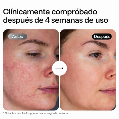 Ulike ReGlow – 4 Modos de terapia en 1: Una solución completa para el cuidado de la piel